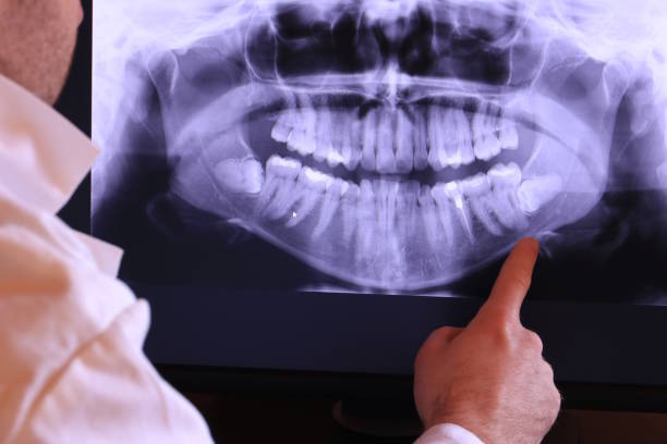 Best Knocked-Out Tooth (Avulsed Tooth) Treatment in Elmira, NY