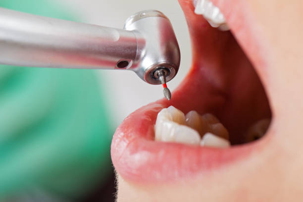Best Emergency Root Canal Therapy in Elmira, NY